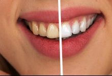 Does Vaping Stain Your Teeth?