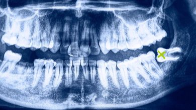 How Long Does Wisdom Tooth Pain Last?