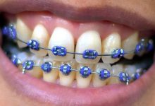 How Much Do Dental Braces Cost?